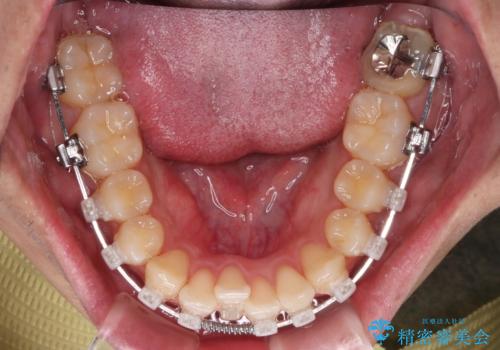 【クリア装置】八重歯とがたつきを綺麗にの治療中