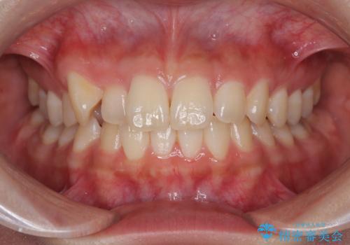 マウスピース矯正が煩わしい ワイヤー装置での非抜歯矯正の症例 治療前