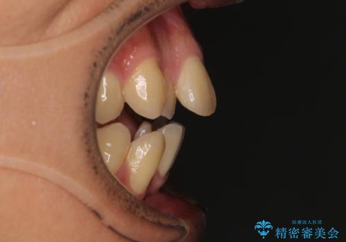 【モニター】前歯のデコボコと口元の出っ張りを改善!目立たない矯正で自然な笑顔にの治療前