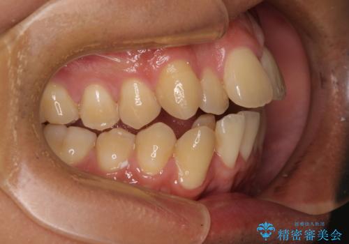 【モニター】前歯のデコボコと口元の出っ張りを改善!目立たない矯正で自然な笑顔にの治療前