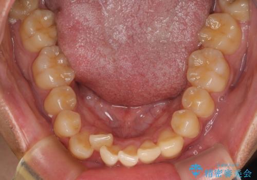 【モニター】前歯のデコボコと口元の出っ張りを改善!目立たない矯正で自然な笑顔にの治療前