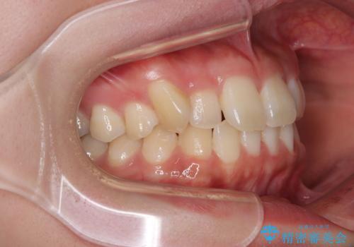 マウスピース矯正が煩わしい ワイヤー装置での非抜歯矯正の治療前