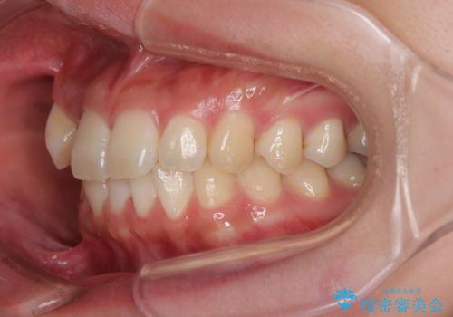 マウスピース矯正が煩わしい ワイヤー装置での非抜歯矯正の治療前