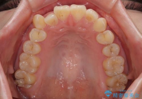 マウスピース矯正が煩わしい ワイヤー装置での非抜歯矯正の治療前