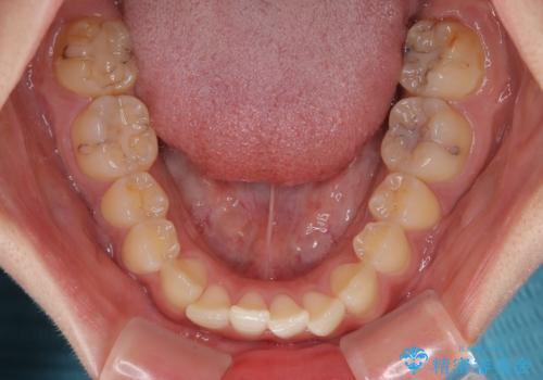 マウスピース矯正が煩わしい ワイヤー装置での非抜歯矯正の治療前