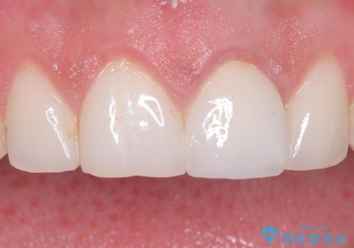 前歯の変色が気になる〈セラミッククラウン〉の症例 治療後