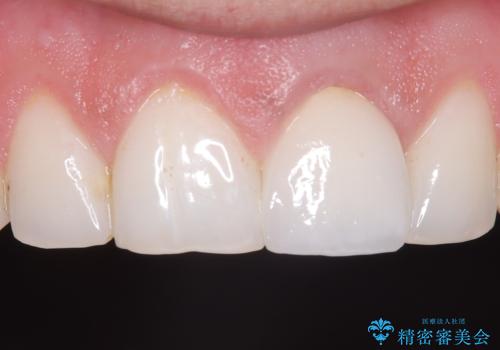 前歯の変色が気になる〈セラミッククラウン〉の治療後