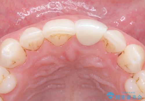 前歯の変色が気になる〈セラミッククラウン〉の治療後