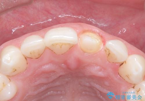 前歯の変色が気になる〈セラミッククラウン〉の治療中