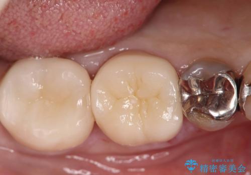 銀歯の下の虫歯|オールセラミッククラウン