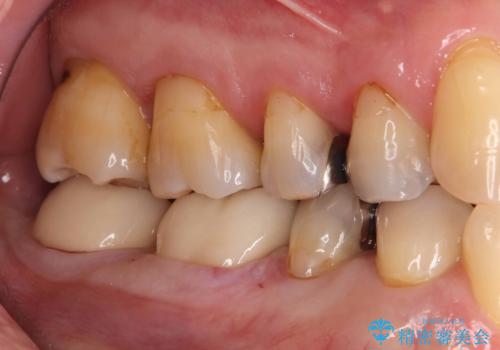 銀歯の下の虫歯|オールセラミッククラウンの治療後