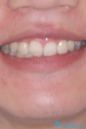 前歯のデコボコと正中のずれを改善!白い装置で目立たない矯正の治療後(顔貌)
