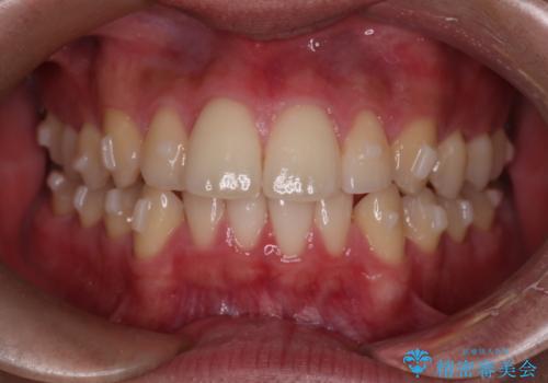 【インビザラインモニター】前歯が出ているのが気になるの治療中