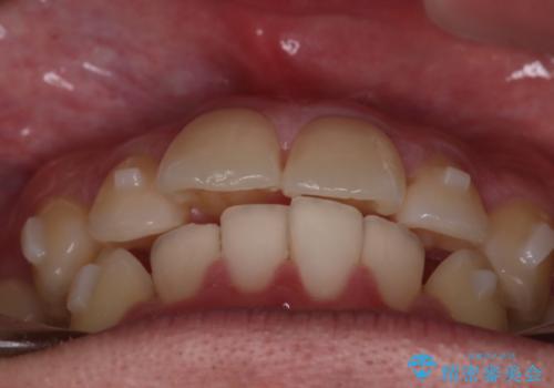 【インビザラインモニター】前歯が出ているのが気になるの治療中