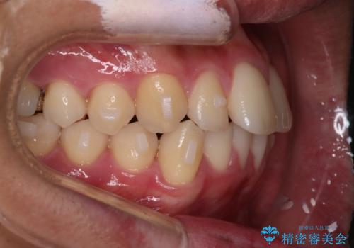 【インビザラインモニター】前歯が出ているのが気になるの治療中