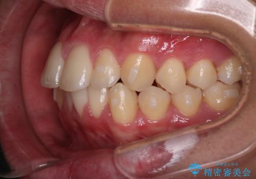 【インビザラインモニター】前歯が出ているのが気になるの治療中