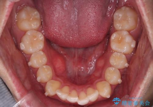 【インビザラインモニター】前歯が出ているのが気になるの治療中