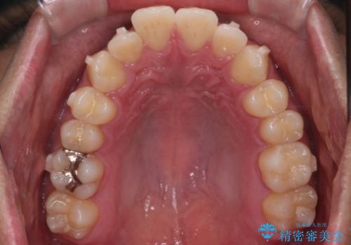 【インビザラインモニター】前歯が出ているのが気になるの治療中