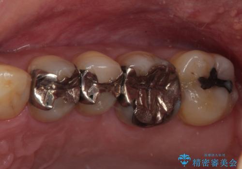 矯正が終わったのでセラミックに変えていきたい オールセラミッククラウンの症例 治療前