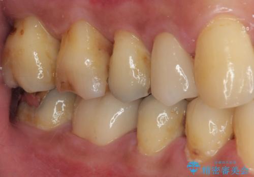 銀歯の下の虫歯を治したい オールセラミッククラウン・セラミックインレー修復の治療前