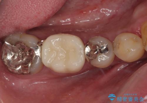 銀歯の下の虫歯を治したい オールセラミッククラウン・セラミックインレー修復の症例 治療前