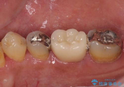 銀歯の下の虫歯を治したい オールセラミッククラウン・セラミックインレー修復の治療前