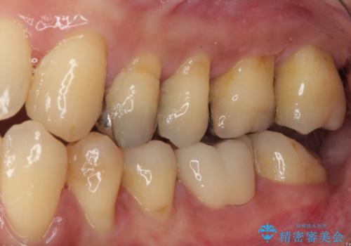 矯正が終わったのでセラミックに変えていきたい オールセラミッククラウンの治療前