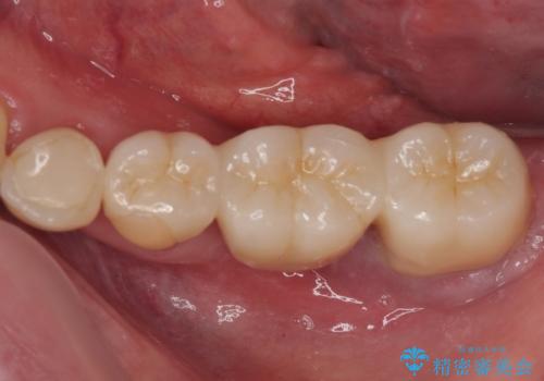 ブリッジから膿が出る 奥歯のインプラント治療の症例 治療前