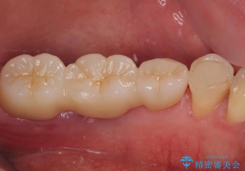 ブリッジから膿が出る 奥歯のインプラント治療の治療前