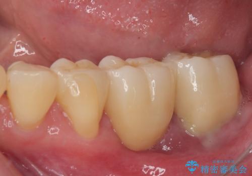 ブリッジから膿が出る 奥歯のインプラント治療の治療前