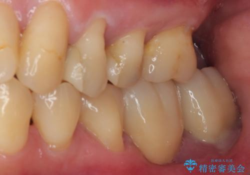 ブリッジから膿が出る 奥歯のインプラント治療の治療前