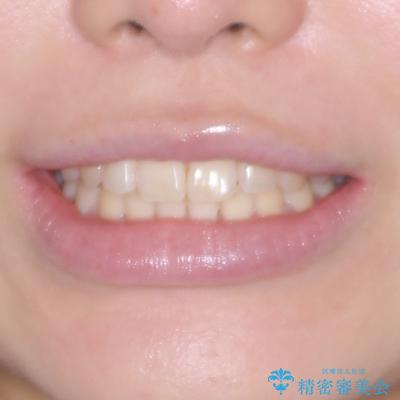 マウスピース矯正が煩わしい ワイヤー装置での非抜歯矯正の治療後(顔貌)