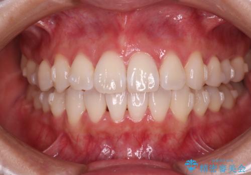 【インビザライン】右側のがたつき治したいの治療中