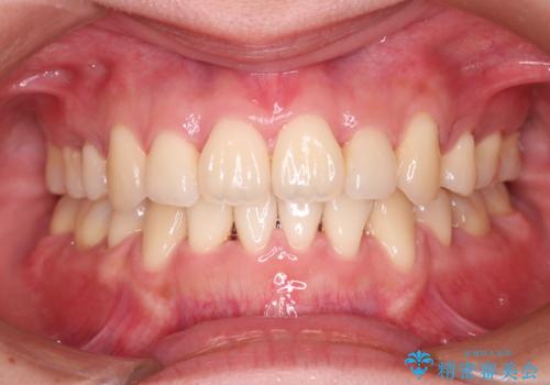 【審美装置】前歯のデコボコを綺麗にの症例 治療後