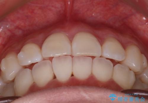 【インビザライン】右側のがたつき治したいの治療中