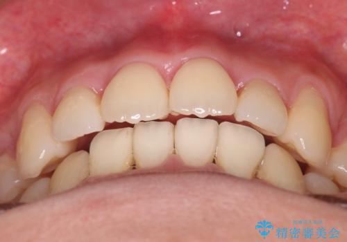 【審美装置】前歯のデコボコを綺麗にの治療後