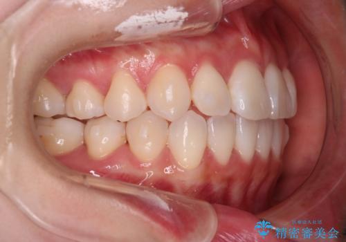 【インビザライン】右側のがたつき治したいの治療中