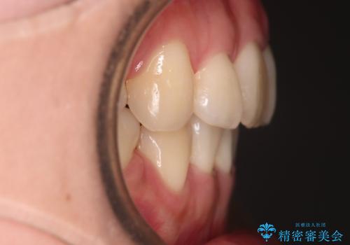 【審美装置】前歯のデコボコを綺麗にの治療後