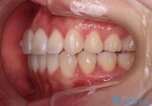 【インビザライン】右側のがたつき治したいの治療中