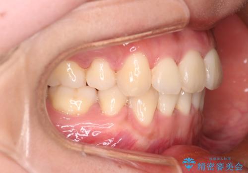 【審美装置】前歯のデコボコを綺麗にの治療後