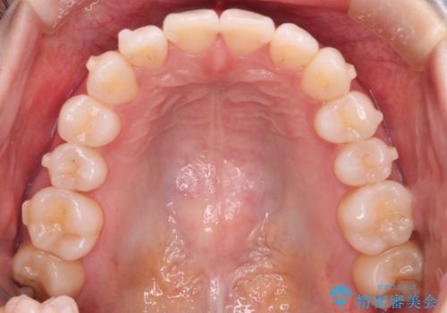 【インビザライン】右側のがたつき治したいの治療中