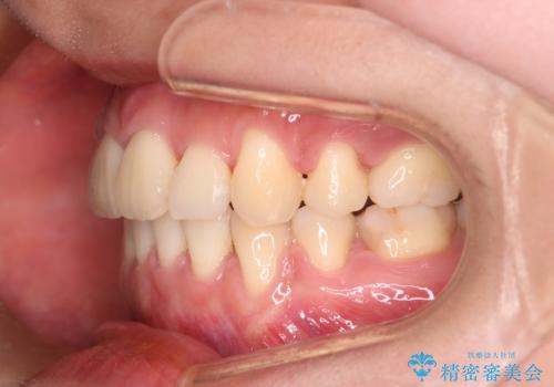 【審美装置】前歯のデコボコを綺麗にの治療後