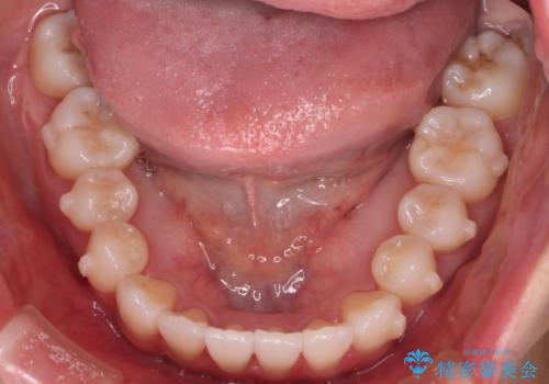 【インビザライン】右側のがたつき治したいの治療中
