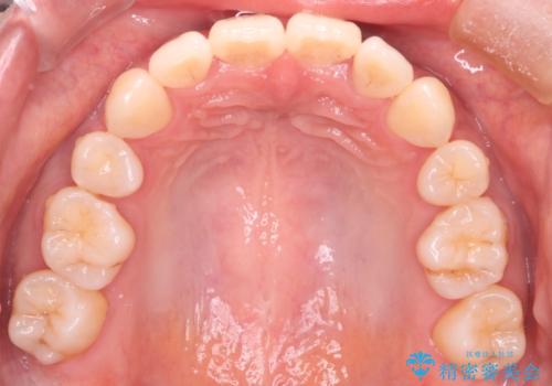 【審美装置】前歯のデコボコを綺麗にの治療後