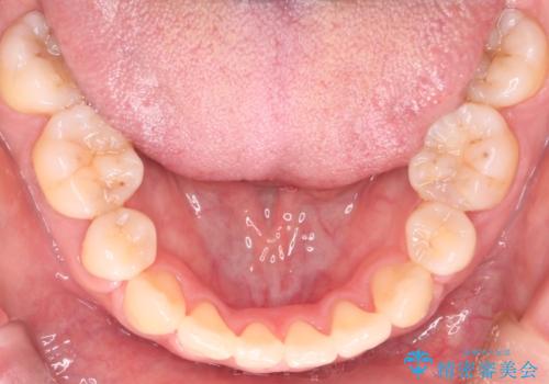 【審美装置】前歯のデコボコを綺麗にの治療後