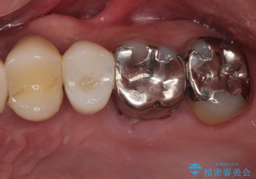 外科処置は一度だけ|抜歯即時インプラントで短期間で自然な見た目への症例 治療後
