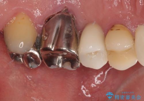 外科処置は一度だけ|抜歯即時インプラントで短期間で自然な見た目への治療後