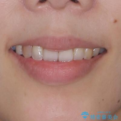 急速拡大装置 狭い骨幅を拡大した上で、顕著なデコボコを改善する抜歯矯正治療の治療後(顔貌)