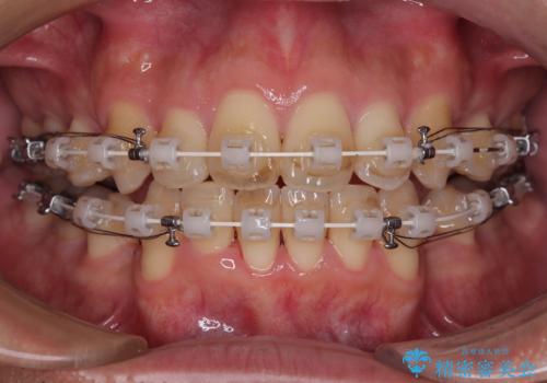 【モニター】前歯のデコボコと口元の出っ張りを改善!目立たない矯正で自然な笑顔にの治療中