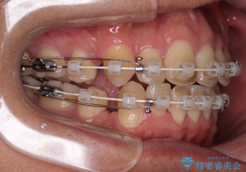 【モニター】前歯のデコボコと口元の出っ張りを改善!目立たない矯正で自然な笑顔にの治療中